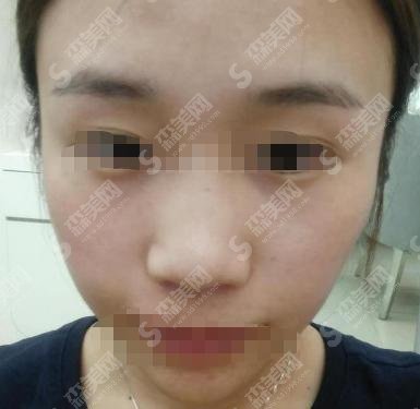 广州曙光医院是正规吗？隆鼻手术案例对比果明X