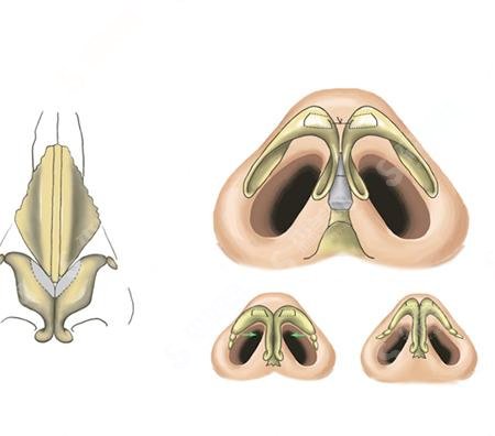 鼻头缩小手术想要果好,这些注意事项要牢记