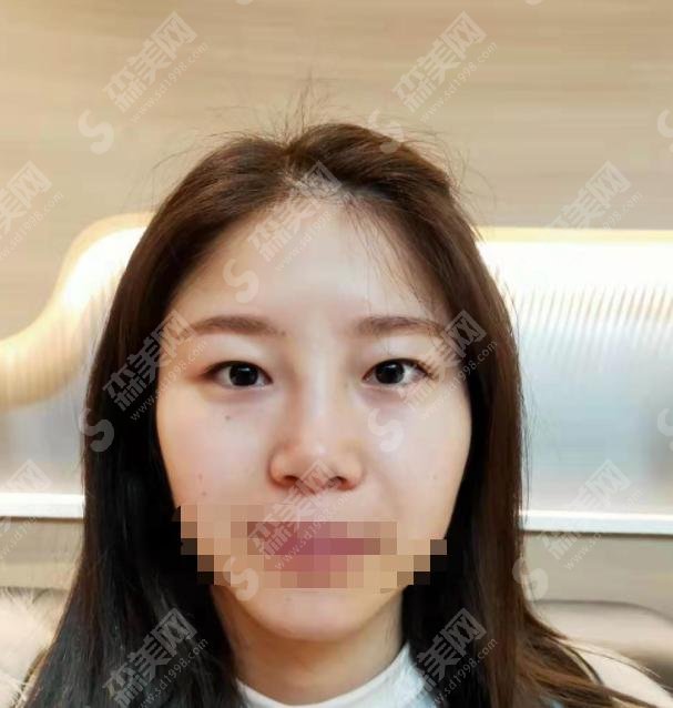 连云港市第一人民医院整形美容外科怎么样？医院做的双眼皮好嘛？真实案例分析