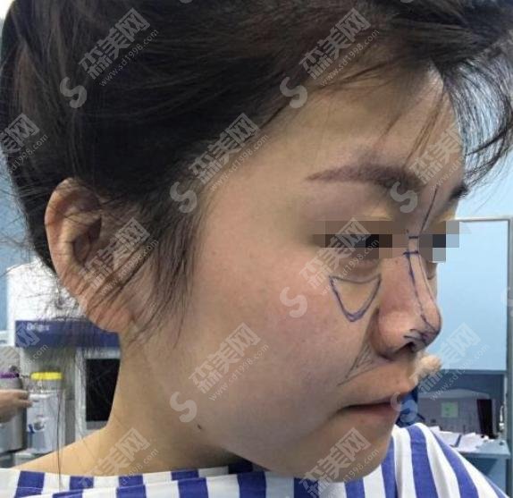 广东省人民医院整形美容科超自然隆鼻果如何?较新案例全览,看一眼就爱上~