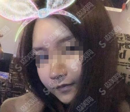 广东省人民医院整形美容科超自然隆鼻果如何?较新案例全览,看一眼就爱上~