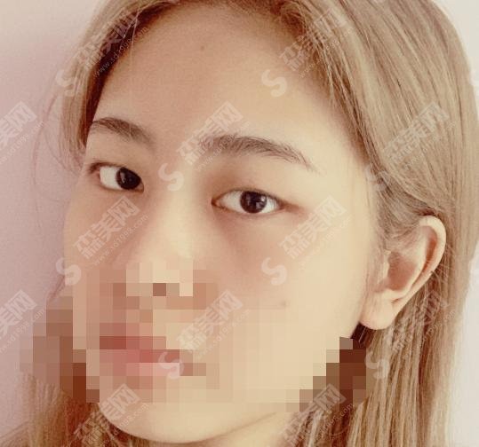 四川省人民医院整形美容外科实力如何？双眼皮手术果见分晓