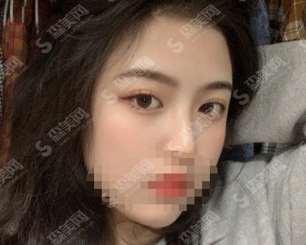 四川省人民医院整形美容外科实力如何？双眼皮手术果见分晓