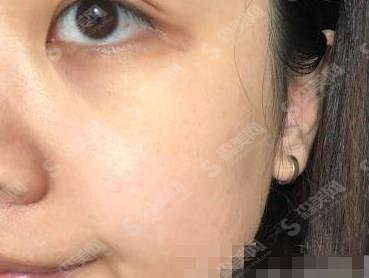 济南省立医院美容科祛斑价格表,祛斑案例及术后果