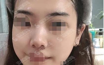 济南省立医院美容科祛斑价格表,祛斑案例及术后果