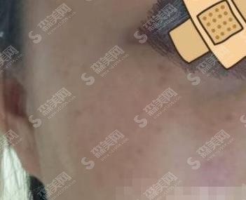 济南省立医院美容科祛斑价格表,祛斑案例及术后果