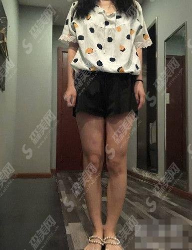 自贡市尚美整形美容医院价目表公布，水动力吸脂果可以吗？