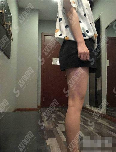 自贡市尚美整形美容医院价目表公布，水动力吸脂果可以吗？