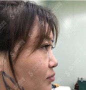 北京壹加壹整形美容医院价格表2021查询，鼻部手术术后恢复及照片对比