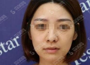 深圳有三甲整容医院吗?北京大学深圳医院纹眉果很棒!