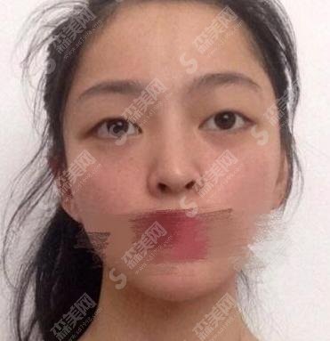 东方和谐整形医院靠谱吗？双眼皮技术好不好？附双眼皮果一览