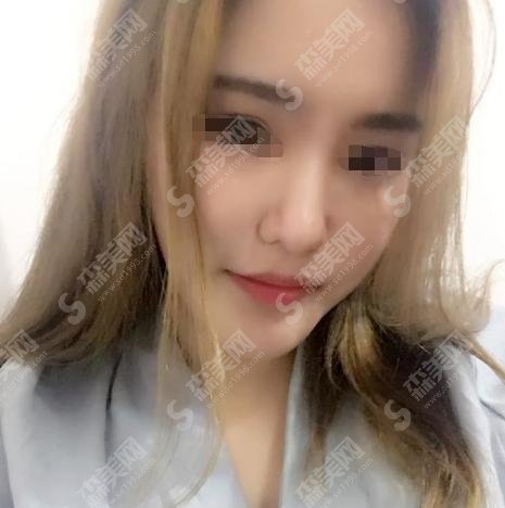 济南中心医院美容科隆鼻经济性价比高吗？真是如此？真人案例为您见证