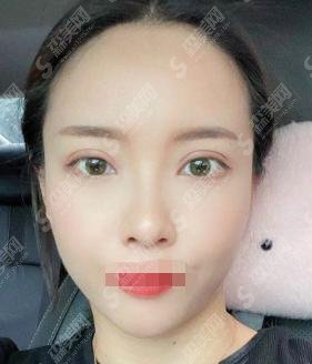 深圳禾丽整形医院精选医生介绍?杨军/胡斌做的双眼皮是漂亮的吗?