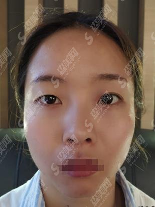 深圳禾丽整形医院精选医生介绍?杨军/胡斌做的双眼皮是漂亮的吗?