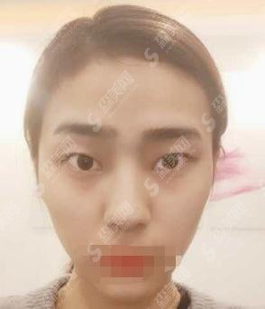 重庆军科医院做的双眼皮怎么样？重庆军科医院的医生技术怎么样