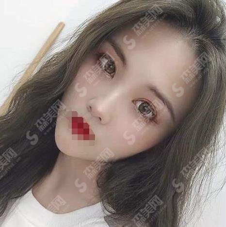 杜园园医生技术好吗?真的靠谱吗?双眼皮修复手术前后对比&项目价格表