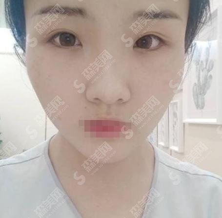 杜园园医生技术好吗?真的靠谱吗?双眼皮修复手术前后对比&项目价格表