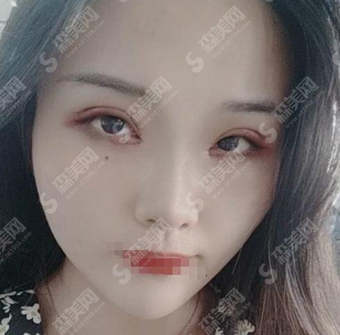 杜园园医生技术好吗?真的靠谱吗?双眼皮修复手术前后对比&项目价格表