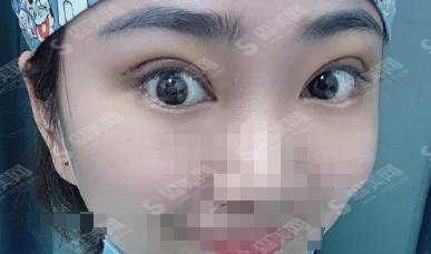 济南瑞丽医疗美容医院靠谱吗？双眼皮案例真实展现