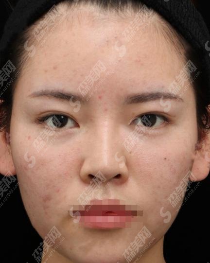 南昌佳美和同济哪个值得去？佳美做的双眼皮果案例一览