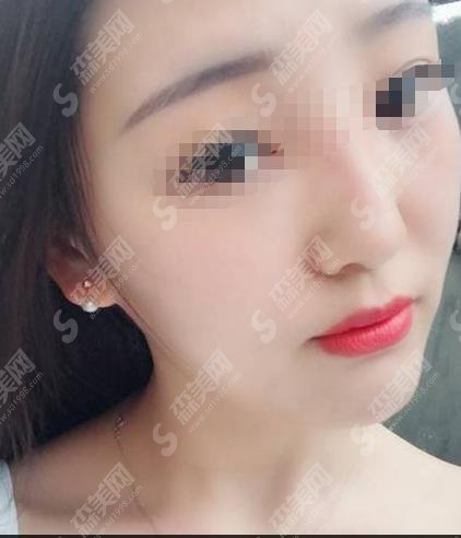 垫鼻梁手术方法有哪些？附隆鼻方法介绍及隆鼻案例分享