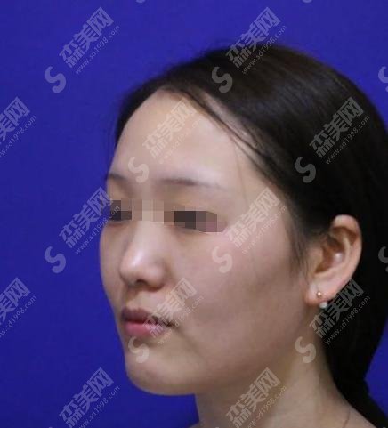 垫鼻梁手术方法有哪些？附隆鼻方法介绍及隆鼻案例分享