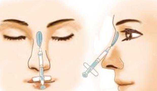 垫鼻梁手术方法有哪些？附隆鼻方法介绍及隆鼻案例分享