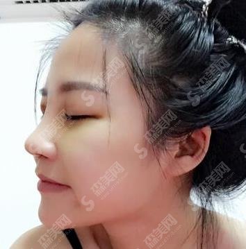 兰州军区总医院整形科隆鼻做的怎样？隆鼻果图及价格出炉啦！