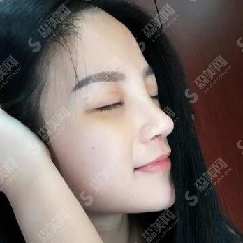 兰州军区总医院整形科隆鼻做的怎样？隆鼻果图及价格出炉啦！