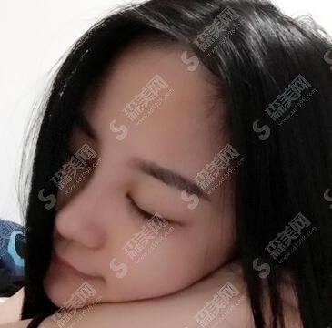 兰州军区总医院整形科隆鼻做的怎样？隆鼻果图及价格出炉啦！