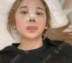 美莱做鼻子怎么样？真实隆鼻案例呈现，追美者值得选择！