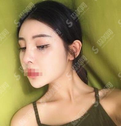 大连新华美天医院靠谱吗？王天大医生隆鼻案例分享让人叹服