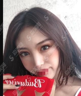 倪云志医生做的双眼皮术后真的越来越自信了!附医院简介及相关价格表