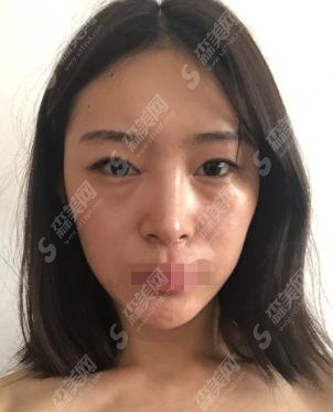 倪云志医生做的双眼皮术后真的越来越自信了!附医院简介及相关价格表