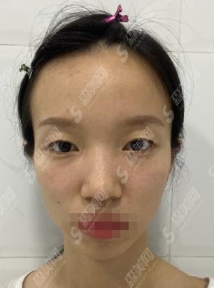 匡瑞霞医生双眼皮案例出炉!气质提高了很多!医生坐诊医院也是如何?