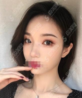 匡瑞霞医生双眼皮案例出炉!气质提高了很多!医生坐诊医院也是如何?