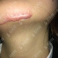 潍坊附属美容科去伤疤果怎么样？医院医生技术了得，果案例对比较为明X！