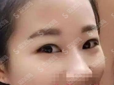 郑大二附院双眼皮果怎么样？医生技术好的案例真实分享！