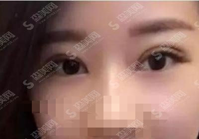 郑大二附院双眼皮果怎么样？医生技术好的案例真实分享！