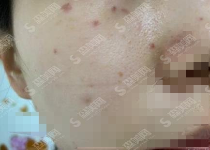 沈阳激光祛斑哪家医院好?沈阳军区总院果和技术果然名不虚全!