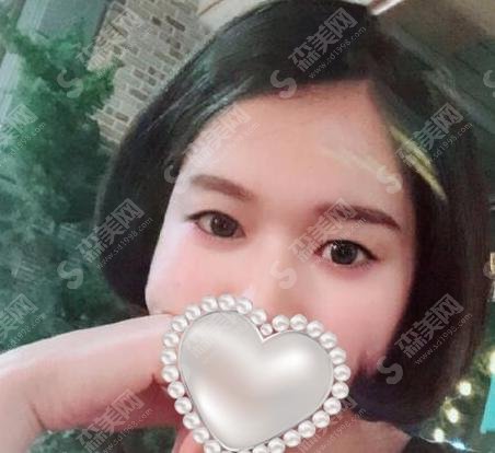 西京医院赵涛医生专业吗？双眼皮案例果让人大开眼界