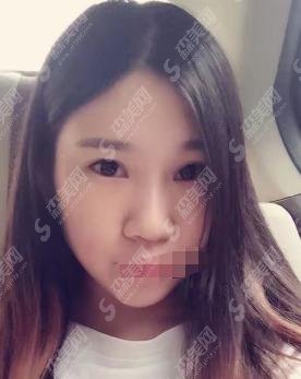 信阳中心医院整形科郑绪珠做的双眼皮案例