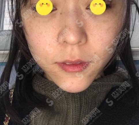 中山二院医生做激光祛斑手术果好不好?张金明医生是否是医院实力担当?