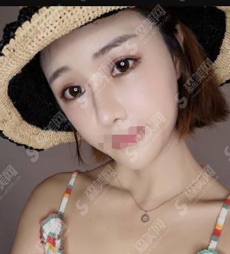 北京三院美容科整形医生推荐!李比等医生介绍!口碑案例在线看!