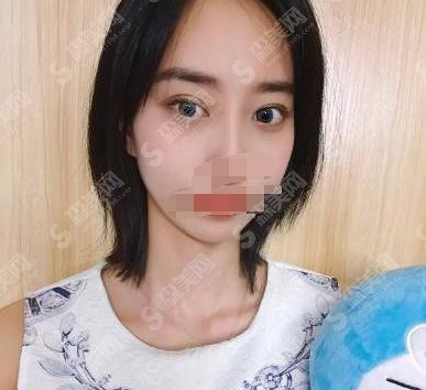 韩国东洋整形外科医院案例精彩分享,果显著值得选择！