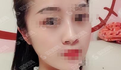 徐州矿务局总医院整形科鼻子果太完美,案例精彩分享&较新价格表