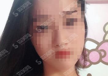 徐州矿务局总医院整形科鼻子果太完美,案例精彩分享&较新价格表