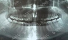 北京市平谷区第二医院口腔科价目表查询，牙齿种植术后反响