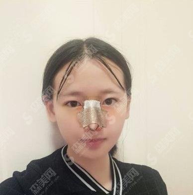 杭州市一医院贾明隆鼻做的可以吗?个人简介/隆鼻案例/价格查询