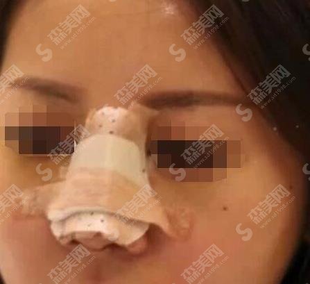 赵延峰做鼻子怎么样?医生口碑如何?案例曝光,快来围观!